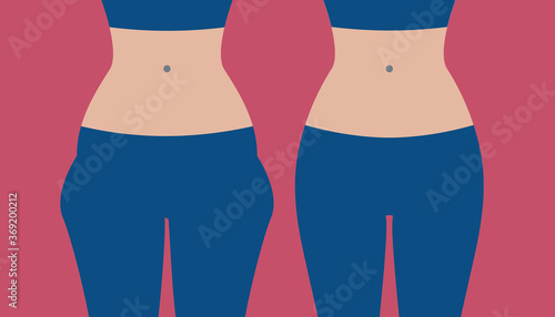 Hip liposuction, hip correction before and after