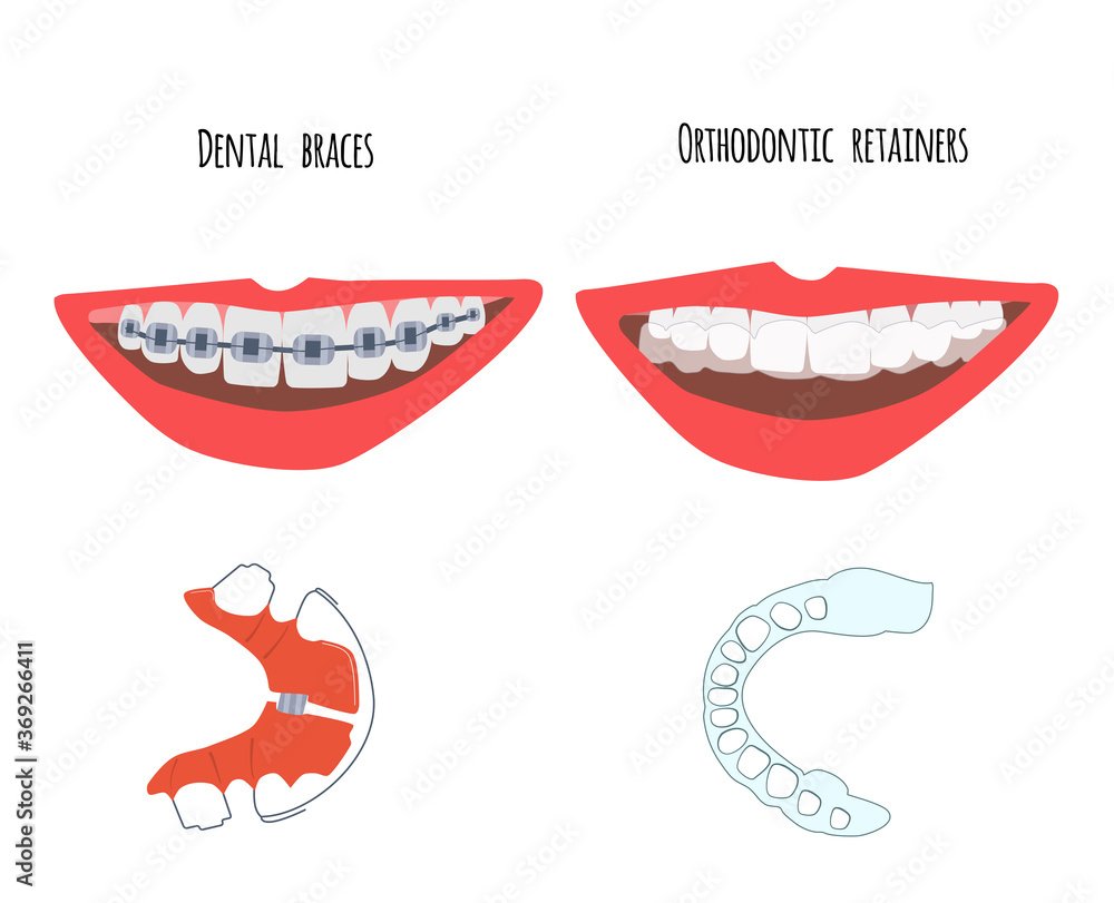Two human mouth with dental braces and orthodontic transparent retainers on teeth. Choice between them. Oral care,bite correction. Beautiful straight  smile. Vector flat illustration for clinic