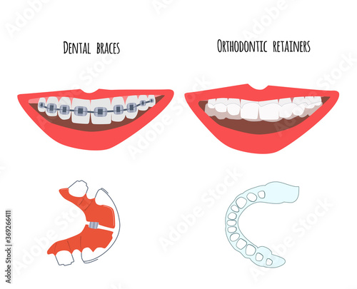 Two human mouth with dental braces and orthodontic transparent retainers on teeth. Choice between them. Oral care,bite correction. Beautiful straight  smile. Vector flat illustration for clinic