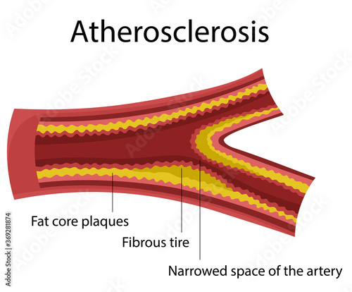 Atherosclerosis. Heart disease