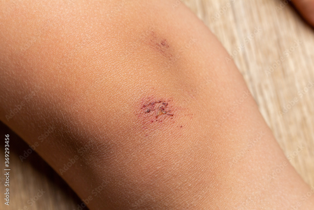wounds, scratches, abrasions on the child’s leg, knee close up wounds, scratches, abrasions on the child’s leg, knee close up