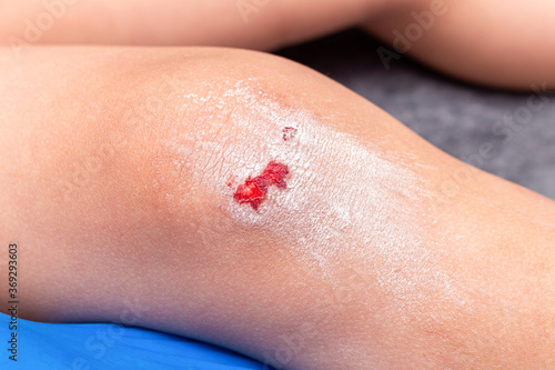 wounds  scratches  abrasions on the child   s leg  knee close up