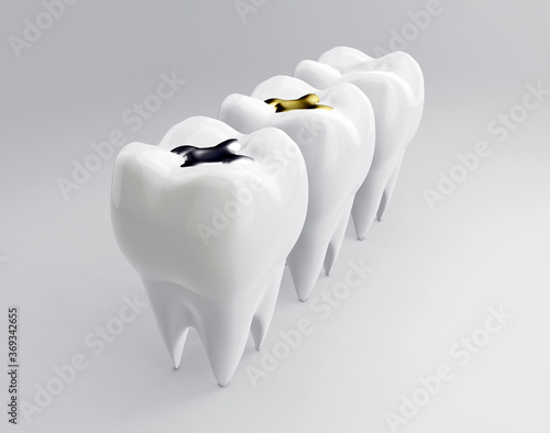 Fotografie Teeth with gold, amalgam and composite inlay dental filling