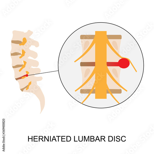 Illustration demonstration of human herniated lumbar disc