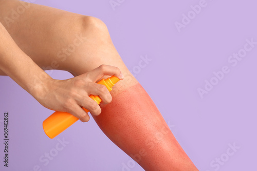 Woman with red sunburned skin applying cream against color background