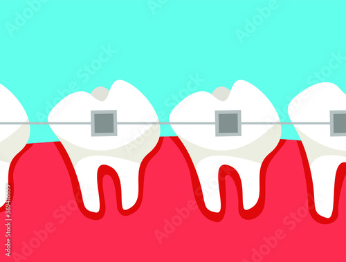 The oral cavity with teeth on which braces are worn. Flat vector illustration.