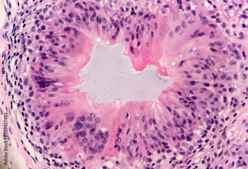 Foto Heavy foreign-body inflammatory reaction in a woman's skin resulting from injection of dermal fillers (pale blue substance)