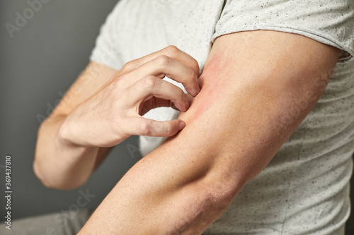 Detail Aufnahme einer Person, die sich juckt und kratzt