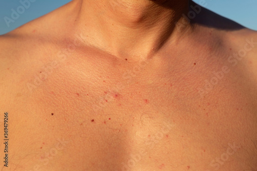 red acne a rash in the chest area of a guy. closeup. Unhealthy skin, dermatosis, purulent dermatitis carbuncle, furuncle, diseases of the skin and hair follicles purulent foliculitis