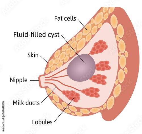 Cyst in the female Breast. Large fluid filled cyst located among lobules. Medical vector illustration marked with lines.