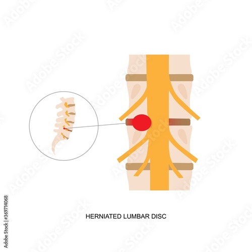 Illustration demonstration of human herniated lumbar disc.