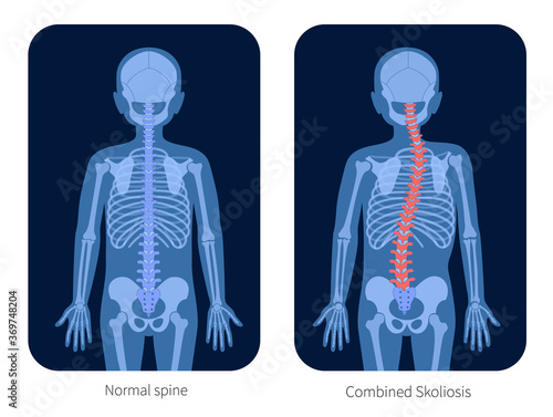 Spine X ray