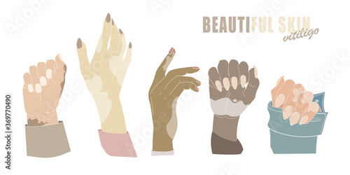 Hands with age spots or vitiligo isolated vector. Hand gestures with genetic skin disease. Woman's hands with manicure