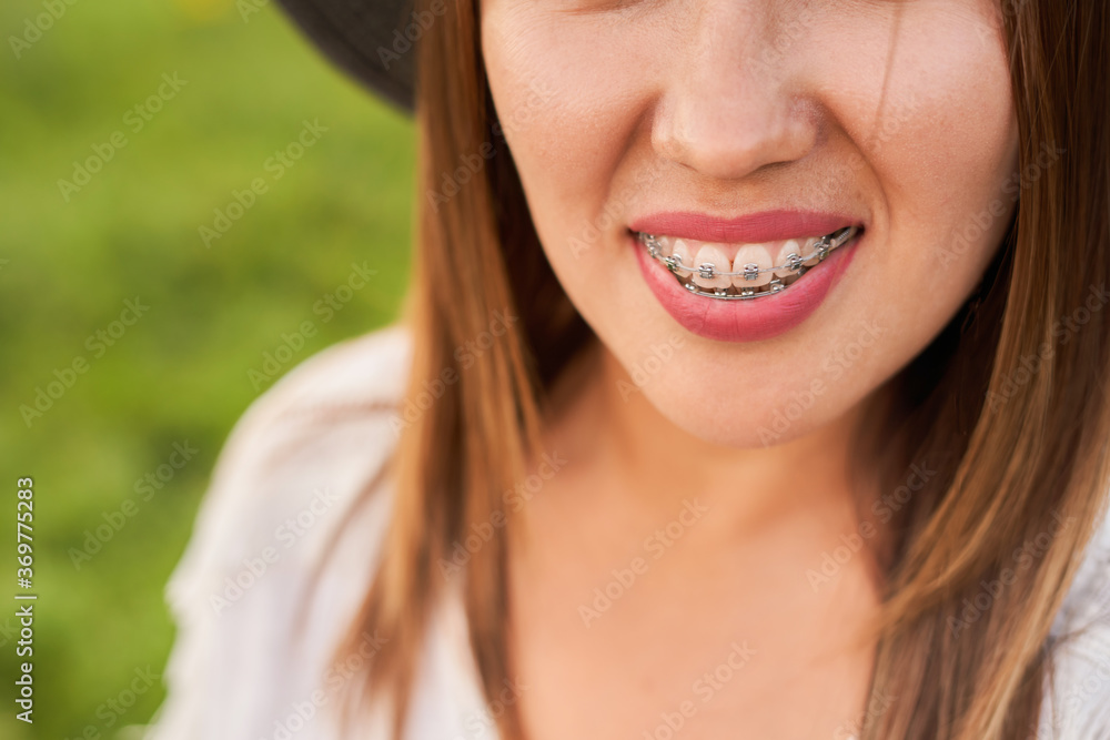 Smile not ashamed of braces, smile of a girl close-up, self-ligating braces Smile not ashamed of braces, smile of a girl close-up, self-ligating braces