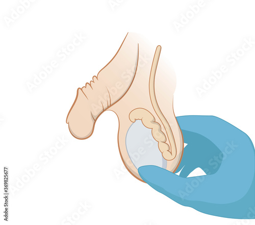 Testicular cancer examination. Scrotal mass palpation