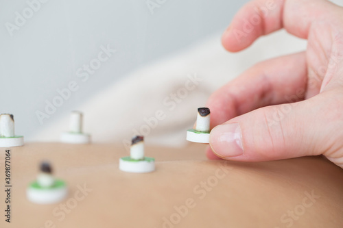 背中にお灸をする女性