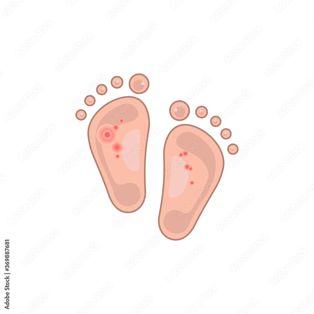 flat child foot with redness flat child foot with redness