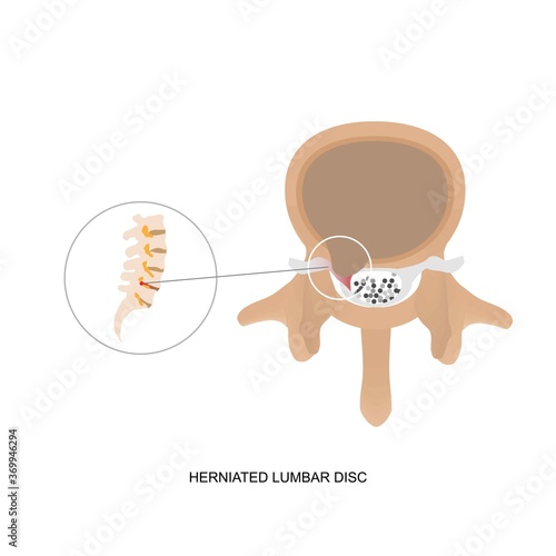 Illustration demonstration of human herniated lumbar disc.