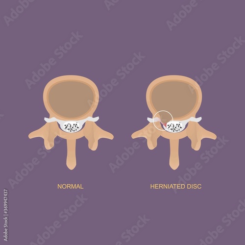 Illustration demonstration axial view of human herniated lumbar disc