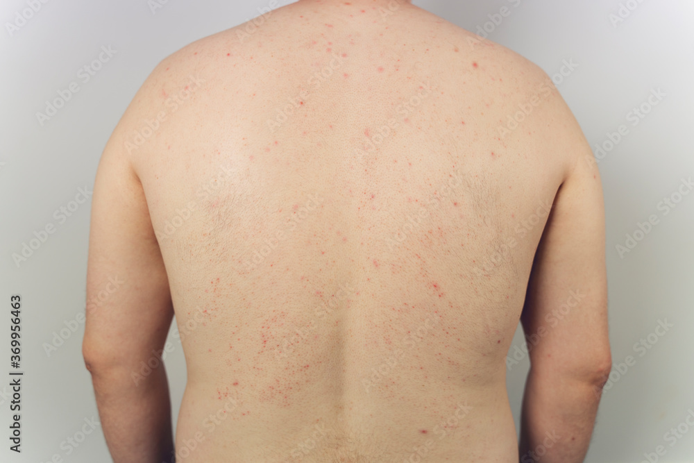 man posing in a photo Studio. thin body that's covered with moles and pimples. troubled skin. skin diseases. dressed in black jeans. white background. back acne man posing in a photo Studio. thin body that's covered with moles and pimples. troubled skin. skin diseases. dressed in black jeans. white background. back acne