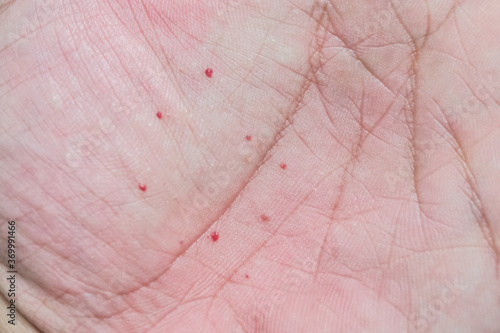 Atopic dermatitis (AD) on the hand, also known as atopic eczema or dyshidrotic eczema. Allergy on skin. photo