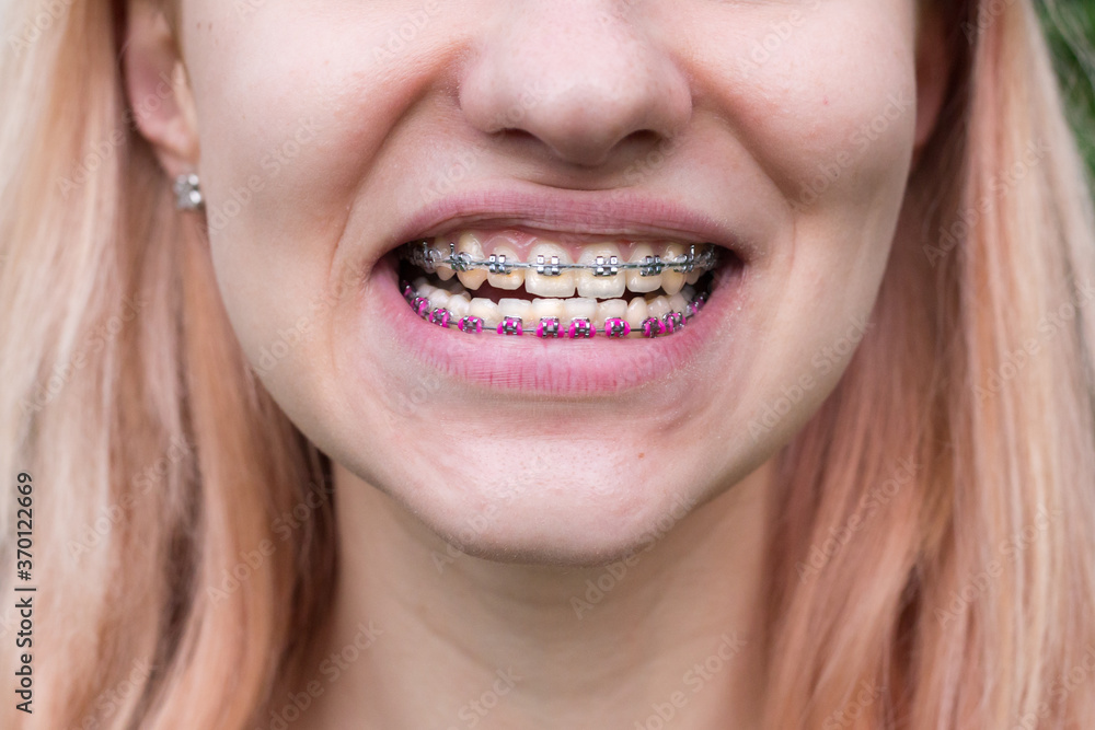 Beautiful young girl with metal dental braces with white teeth Beautiful young girl with metal dental braces with white teeth
