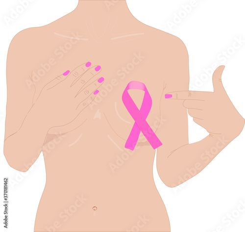 A closeup of a pink badge ribbon on a woman's breast to support the cause of breast cancer. Health care, medicine and breast cancer awareness concept. 