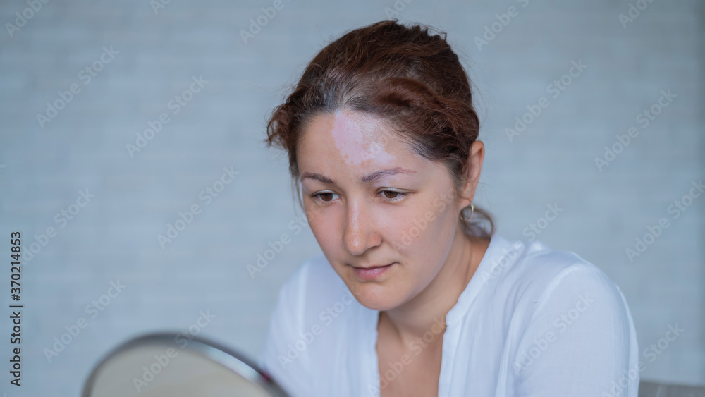 Portrait of a Caucasian woman with vitiligo. A girl with a white pigment spot on her forehead looks in the mirror. An autoimmune disease affecting the skin. Portrait of a Caucasian woman with vitiligo. A girl with a white pigment spot on her forehead looks in the mirror. An autoimmune disease affecting the skin.