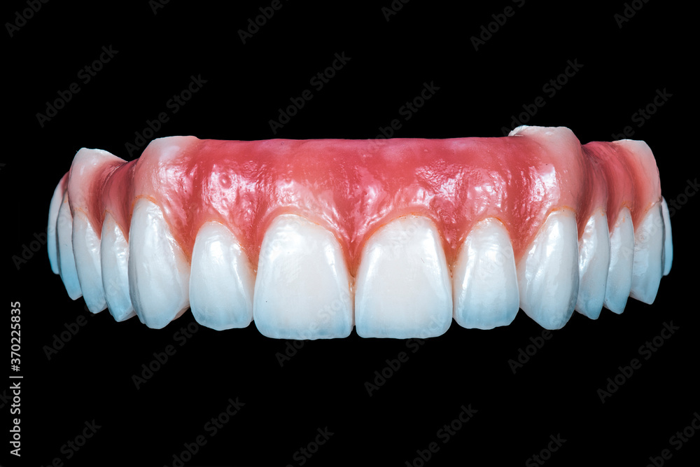 full ceramic tooth on 6 implants ( all on 6 )