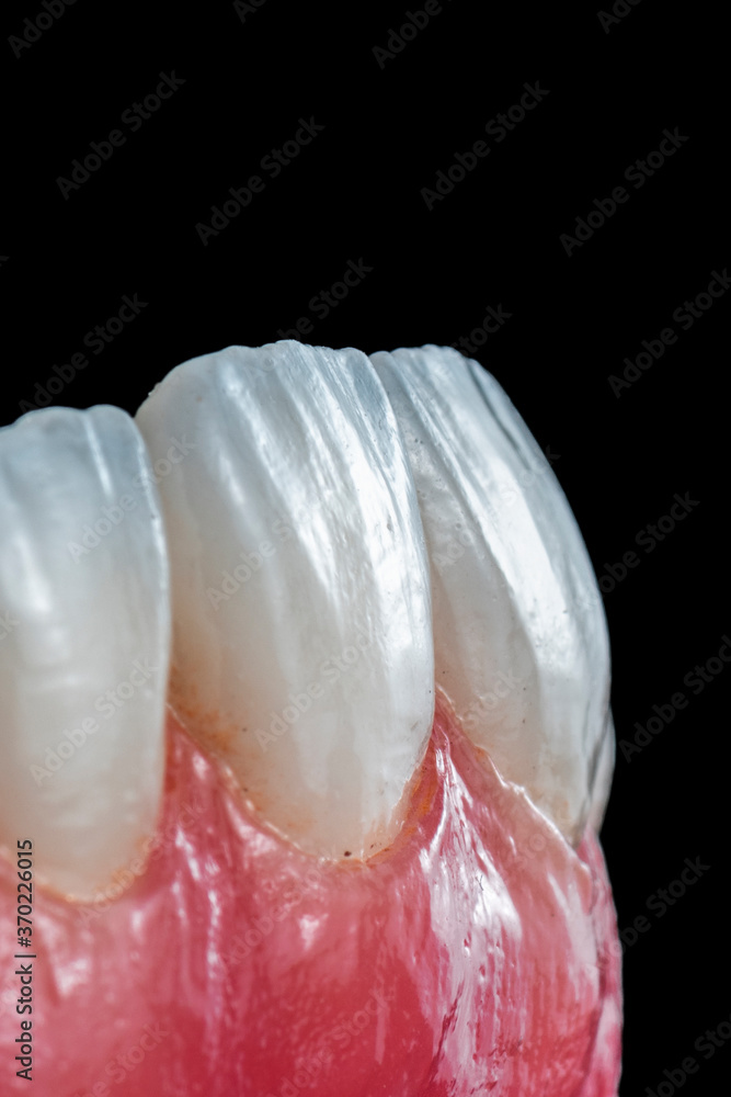 full ceramic tooth on 6 implants ( all on 6 )