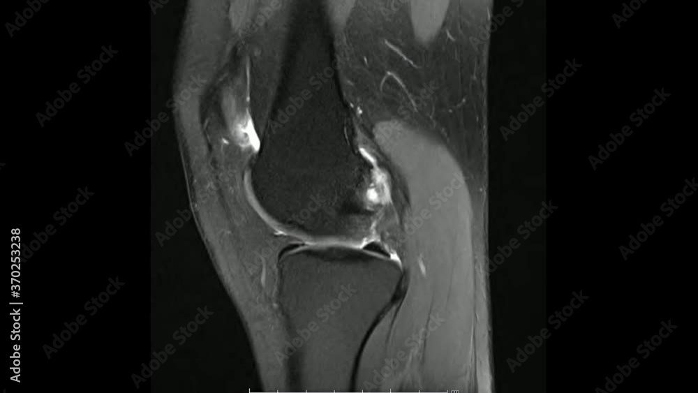 Magnetic Resonance images of The Knee joint Sagittal Proton density ...