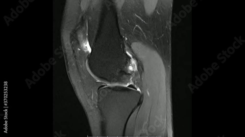 Magnetic Resonance images of  The Knee joint Sagittal Proton density Images in cine mode (MRI Knee joint) showing the anatomy of the knee