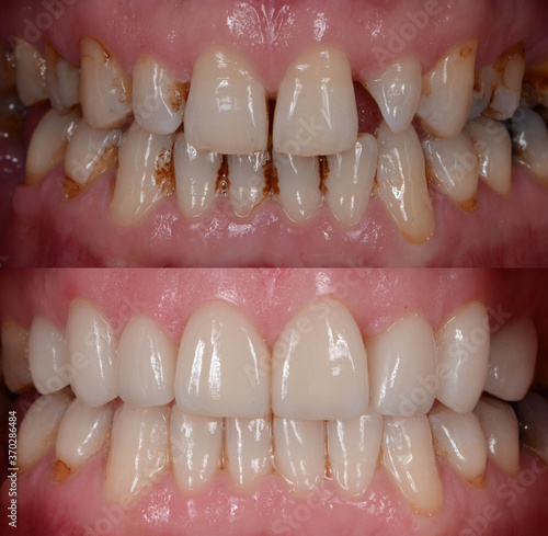 Obraz na plátně The natural-looking smile makeover with the dental ceramic veneer and crown