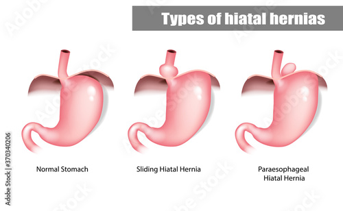 Types of hiatal hernias sliding and paraesophageal.