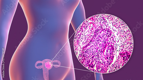 Uterine cancer, illustration and micrograph photo