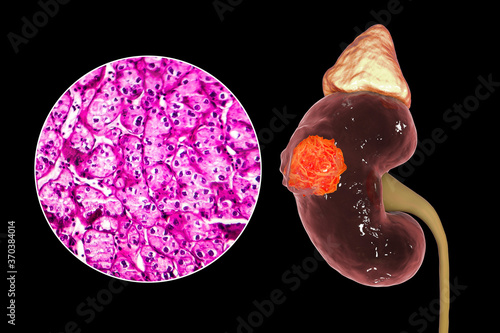 Kidney cancer, illustration and light micrograph photo