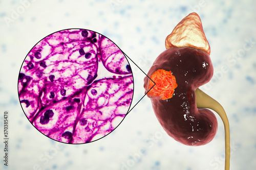 Kidney cancer, illustration and light micrograph photo