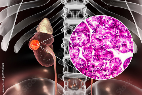 Kidney cancer, illustration and light micrograph photo