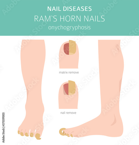 Nail diseases. Onychogryphosis, Ram`s horn nail. Medical infographic design