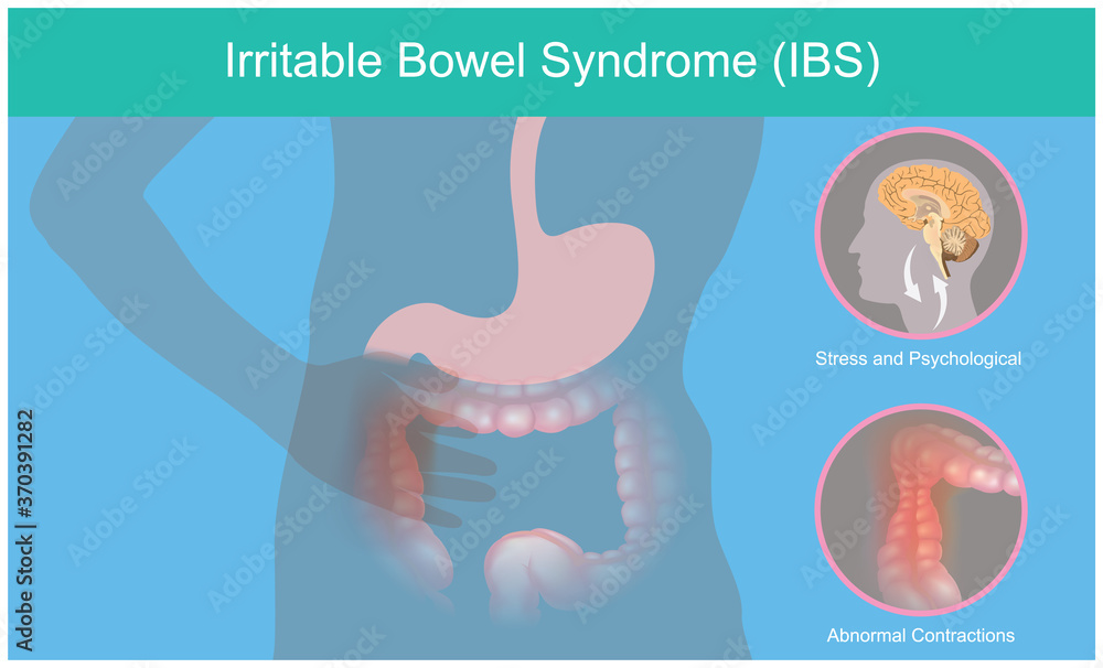 Irritable Bowel Syndrome. Illustration explain abnormal contractions