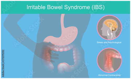Irritable Bowel Syndrome. Illustration explain abnormal contractions and pain perception human bowel as a result of the brain stress responses. .