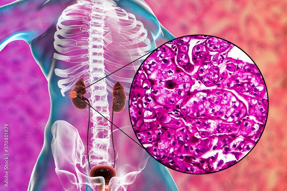 Kidney cancer, illustration and light micrograph Kidney cancer, illustration and light micrograph