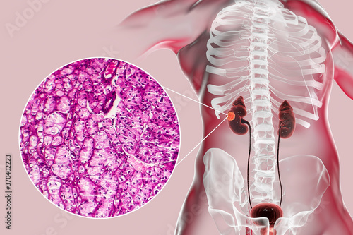 Fotografía Kidney cancer, illustration and light micrograph