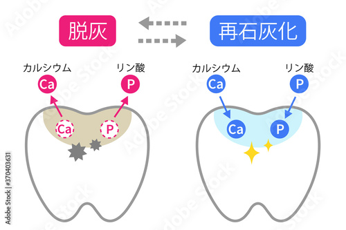歯　脱灰と再石灰化