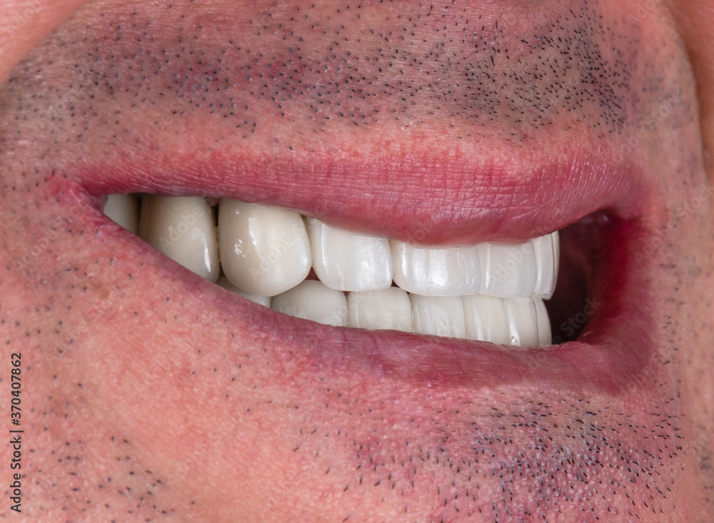 Obraz premium all on six dental ceramic restoration on implants