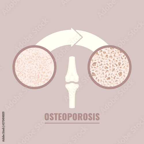 Normal bone after mass loss process caused by osteoporosis.  Close-up of normal femur cavity tissue and osteoporotic texture. Skeletal system disease. Senior osteopathy medical vector illustration.