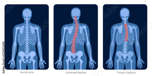 Spine X ray photo