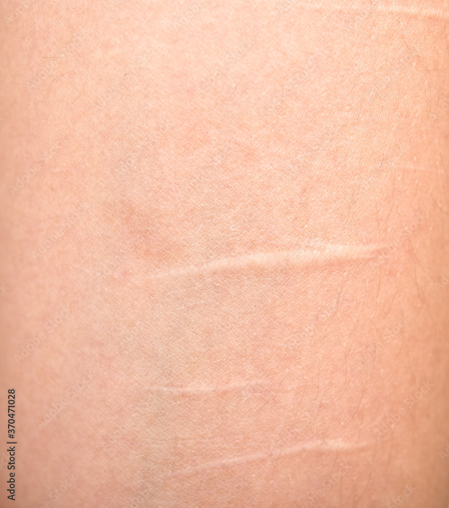 Scars on skin