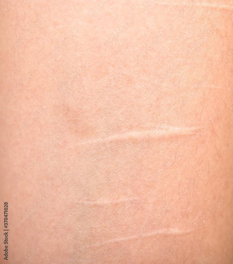 Fototapeta premium Scars on skin