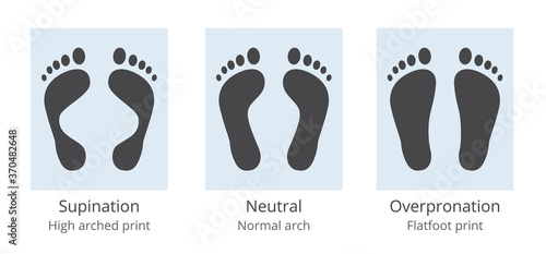 Foot arch variation diagram - supination and overpronation and normally arched human sole footprint